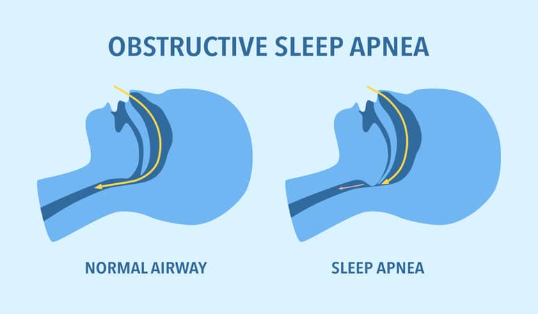 Airway-focused orthodontic treatment at Advanced Orthodontics in Everett, WA addressing breathing issues