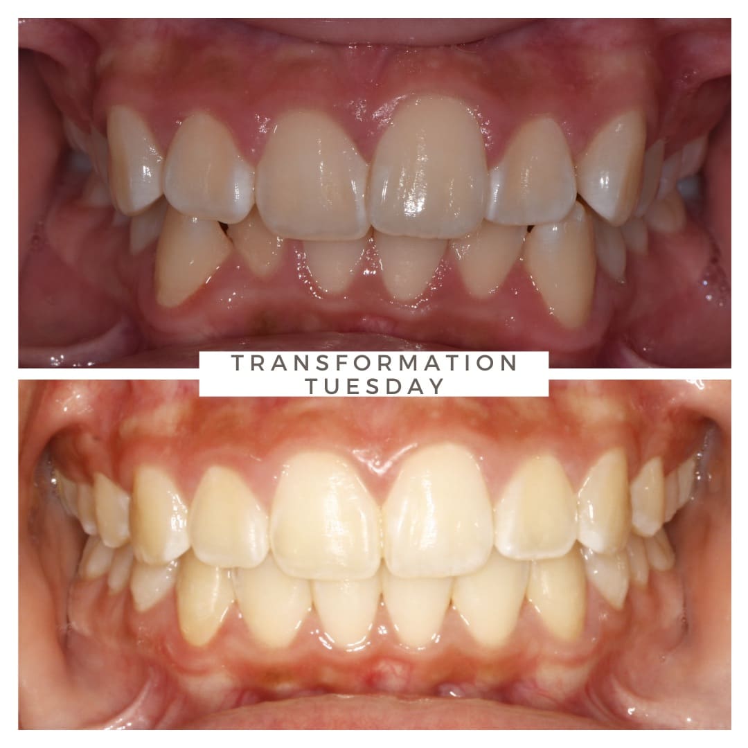 Before and after orthodontic treatment results at Advanced Orthodontics in Everett, WA showing healthier, straighter, more confident smiles.