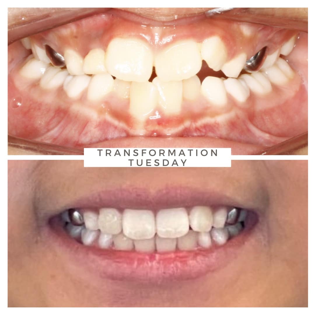 Before and after orthodontic treatment results at Advanced Orthodontics in Everett, WA showing healthier, straighter, more confident smiles.