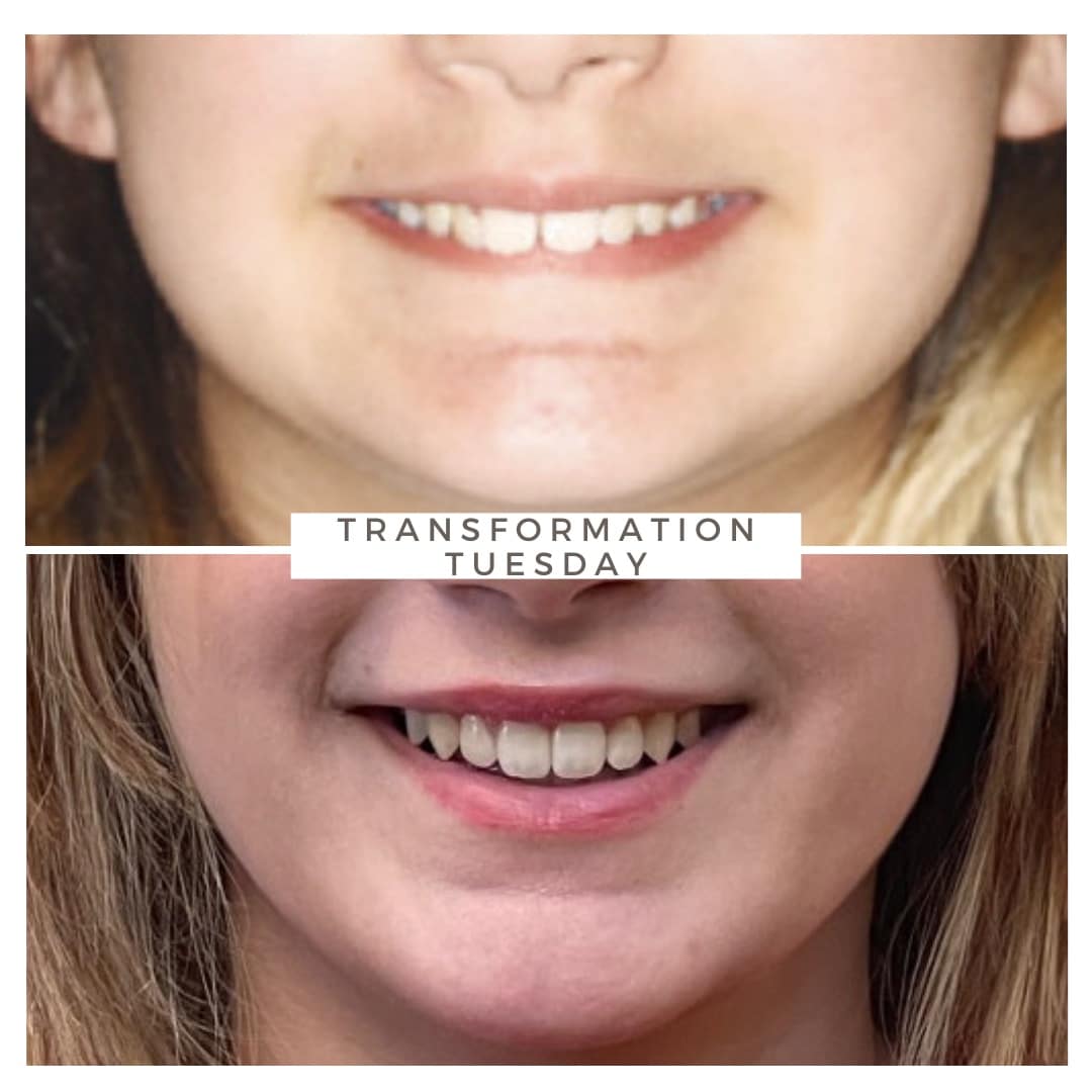Before and after orthodontic treatment results at Advanced Orthodontics in Everett, WA showing healthier, straighter, more confident smiles.